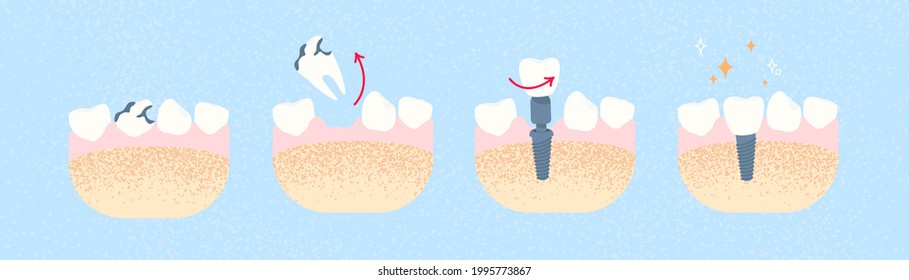 Tooth implantation. Implant. Dentistry and orthopedics concept.