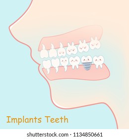 tooth with implants concept on the blue background