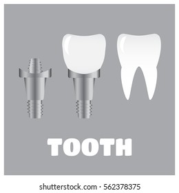 Tooth implants and normal tooth isolated on white background. Screw implant, dental inplant tooth