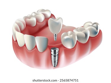 Tooth implants, tooth restoration, tooth implant examples On white background, Vector illustration