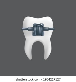 A tooth with a metal brace. Orthodontic treatment concept. 3d realistic vector illustration of a dental ceramic model isolated on a grey background