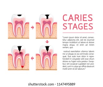 Tooth on different stages of dental caries development. Enamel caries, Dentin caries, Pulpitis and Periodontitis. Design for banner and poster. Illustration on white background.