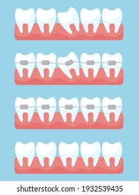 Tooth with orthodontic braces set. Illustrations of before and after treatment and correction with brackets on light blue background. Dental clinic and orthodontist services concep