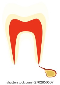 Um dente com granuloma periapical	
