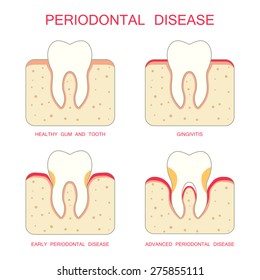 tooth periodontal disease, dental gum periodontists