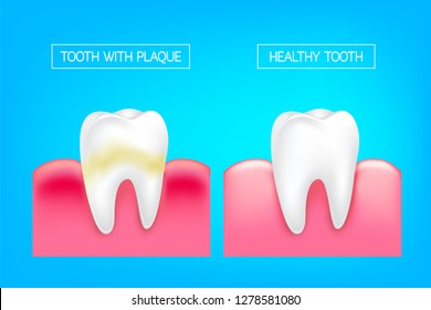 Tooth with plaque and healthy tooth comparision.  Teeth Whitening. Dental care Concept. Oral Care, teeth restoration. Yellow and white teeth.