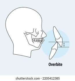 Tooth problem. side view man with misaligned teeth. malocclusion