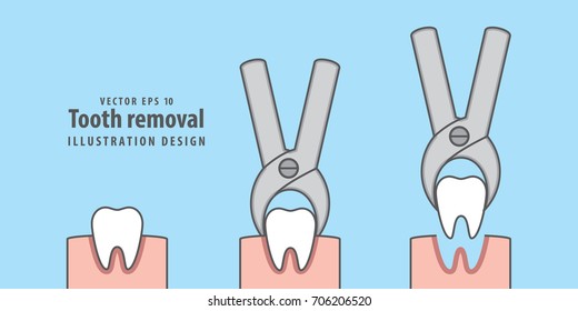 Tooth removal illustration vector on blue background. Dental concept.