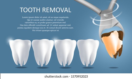 Tooth removal vector medical poster banner template. White healthy teeth and bad tooth extracted with dental pliers. Tooth extraction procedure, dental surgery concept.