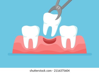 Tooth is removed by forceps. Teeth row with dental implant. Vector illustration isolated on blue background.