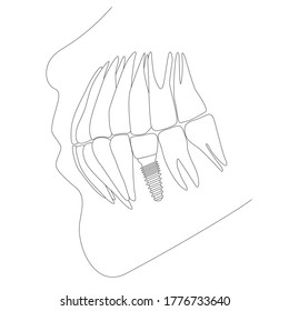 Tooth replacement. Dental implant concept. Vector scheme illustration