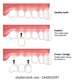 tooth replacement dental medical vector illustration isolated on white background