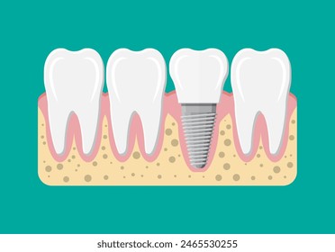 Tooth restoration. Dental implant. Dental prostheses. Artificial teeth with steel pin. Oral care, stomatology and dentistry. Vector illustration in flat style