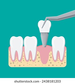 Tooth restoration. Installation of the dental implant. Dental prostheses. Artificial teeth with steel pin. Oral care, stomatology and dentistry. Vector illustration in flat style