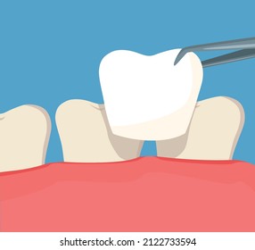 Tooth restoration. Installing a new veneer on a discolored tooth. Vector cartoon illustration.