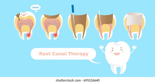 tooth with root canal therapy on the blue background