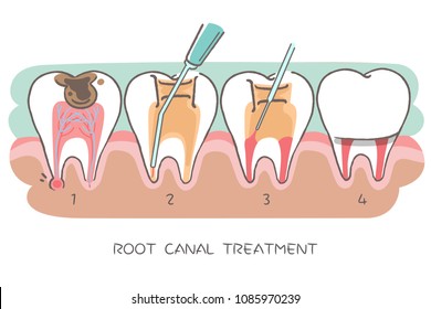 tooth with root canal treatment on a white background