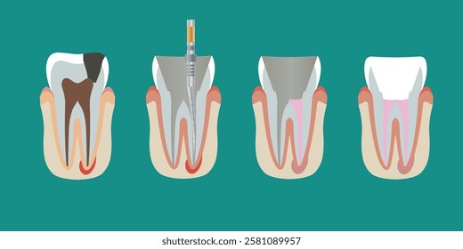 Tooth root canal treatment process