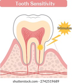 Tooth Sensitivity Diagram, Dentin Exposure and Nerve Stimulation Illustration
