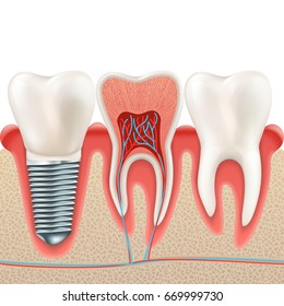 Tooth set. Human realistic teeth and Dental implant. And also includes EPS 10 vector