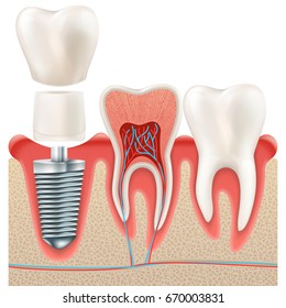 Tooth set. Human realistic teeth and Dental implant. And also includes EPS 10 vector