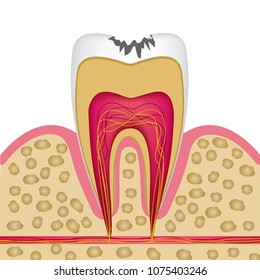 Tooth structure in cross section with caries to use on posters, booklets, leaflets, website. Vector illustration.