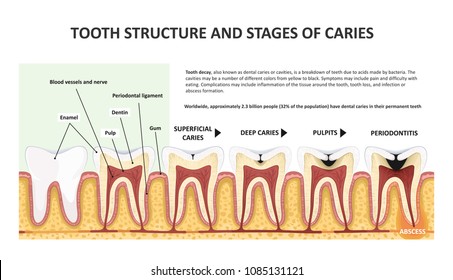Tooth structure and stages of caries