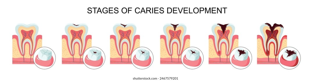 Tooth structure and types of dental caries. Stain, enamel caries, dentin, pulpitis, periodontitis on white background. Flat vector illustration for medical design