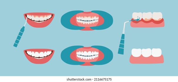 Tooth tartar cleaning. Oral cavity before and after using the water irrigator. Teeth with inflamed gums close-up, healthy smile. Collection flat vector illustration