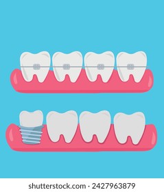 Tooth, teeth, implant, dental vector illustration set