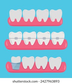 Tooth, teeth, implant, dental vector illustration set