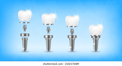 Tooth and teeth implant for stomatology set. Implant structure models. Screw denture orthodontic implantation. stomatology clinic concept. Realistic isolated 3D vector ​illustration.