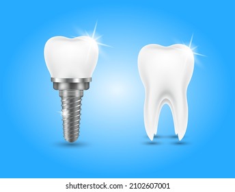 Tooth and teeth implant for stomatology. Implant structure models. Screw denture orthodontic implantation. stomatology clinic concept. Realistic isolated 3D vector ​illustration.
