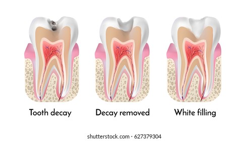 Tooth treatment stages. Tooth decay, decay removed, white filling.