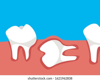 Tooth under gum. Flat Vector illustration in cartoon style.