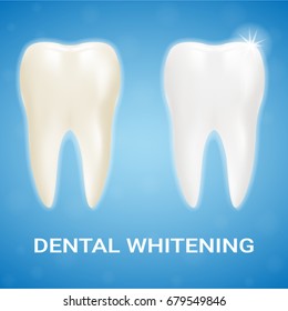 Tooth Veneer, Teeth Whitening, Whitening Toothpaste Isolated On A Background. Realistic Vector Illustration. Healthcare stomatology and cleaning professional teeth illustration