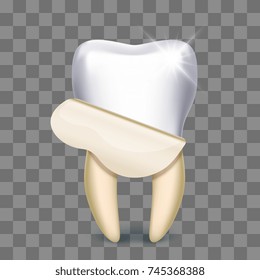 Tooth veneer whitening dental technician isolated on transparent background. Vector illustration