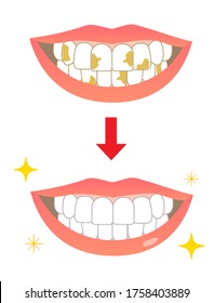 Tooth  Whitening Yellowing Before After