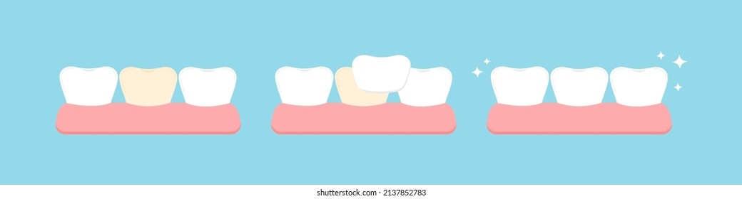 Tooth yellow color and tooth with veneer stage in gum. Teeth crown aesthetic treatment, cleaning, color restoration concept. Flat cartoon dental teeth ceramic reconstriction vector illustration.