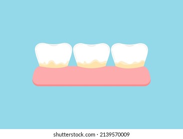 Tooth with yellow tartar plaque icon. Teeth stain treatment, cleaning, whitening concept. Flat cartoon vector illustration. Dental hygiene stained teeth