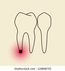 Toothache - Pulpitis