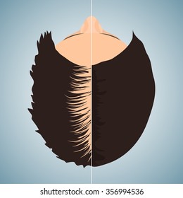 Top view of a balding woman before and after hair treatment and transplantation. Divided image of the head. Two halves. Female alopecia. Health and beauty concept. Isolated vector illustration