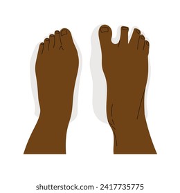 Top view comparison of healthy and deformed feet after wearing regular and barefoot shoes. Dark skin human feet. Vector illustration