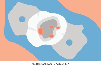 Top View of Decayed Tooth with Gutta-Percha