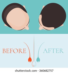 Top view of a man before and after hair treatment and transplantation. Male pattern baldness. Health and beauty concept. Isolated vector illustration.

