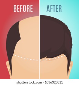 Top view portrait of a man before and after hair treatment and transplantation. Divided image of the head on red and blue background. Two halves. Vector illustration.