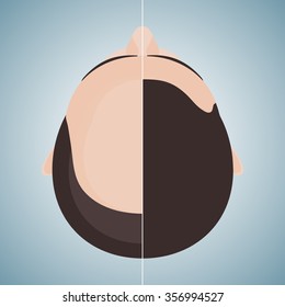 Top view portrait of a man before and after hair treatment and transplantation. Divided image of the head. Two halves. Health care and beauty concept. Isolated vector illustration.