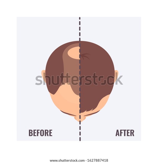 Top view portrait of a man before and\
after hair treatment and transplantation. Divided image of a man\'s\
head with alopecia and restored hairline. Two halves. Beauty\
concept. Vector\
illustration.\
\
