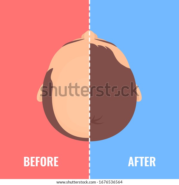 Top view portrait of a man before and after\
hair treatment and  transplantation. Divided image of the head on\
red and blue background. Two halves.  Beauty health care concept.\
Vector illustration.