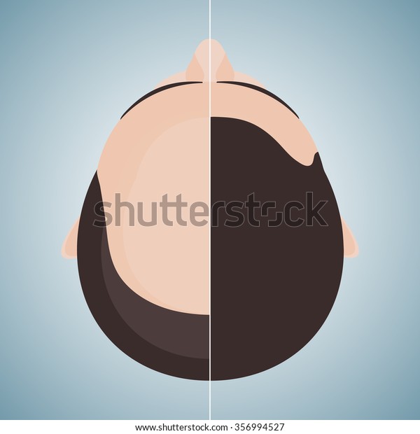 Top\
view portrait of a man before and after hair treatment and\
transplantation. Divided image of the head. Two halves. Health care\
and beauty concept. Isolated vector\
illustration.